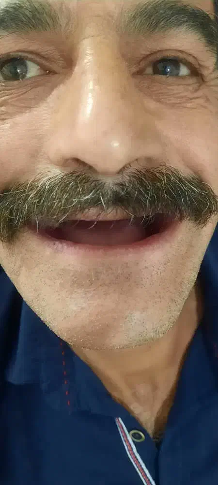 دندان مصنوعی در محل شما با کیفیت تضمینی|خدمات آرایشگری و زیبایی|هشتگرد, شهرک ریحانه|دیوار