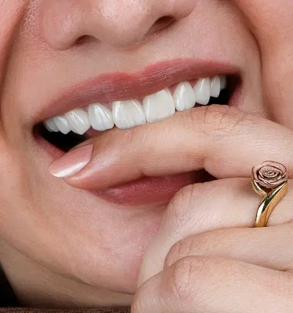 جشنواره کامپوزیت لمینیت روکش عصب ونیر بریدج ترمیم|خدمات آرایشگری و زیبایی|تهران, هفت حوض|دیوار