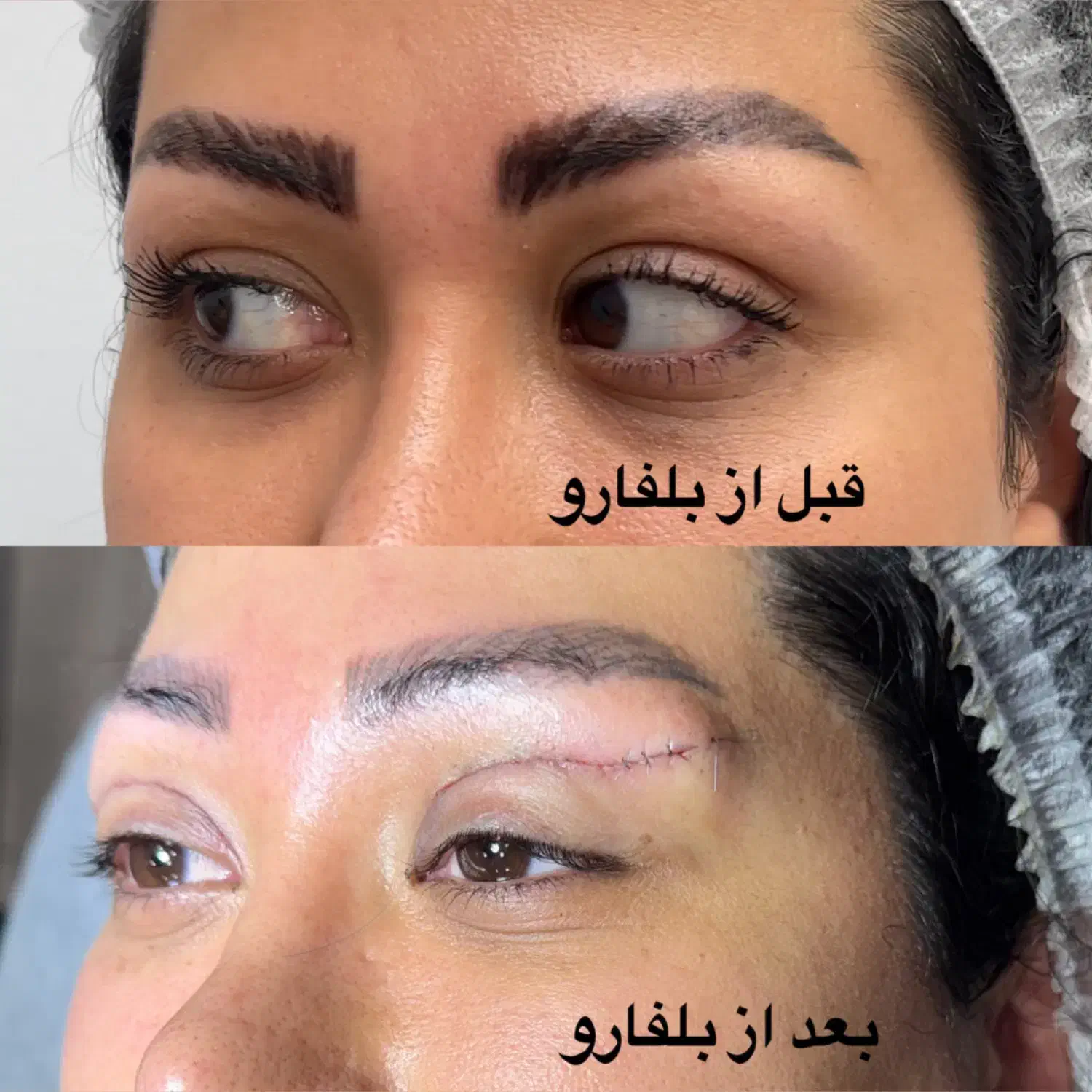 بلفارو روباهی در کلینیک مهرزاد|خدمات آرایشگری و زیبایی|تهران, جردن|دیوار