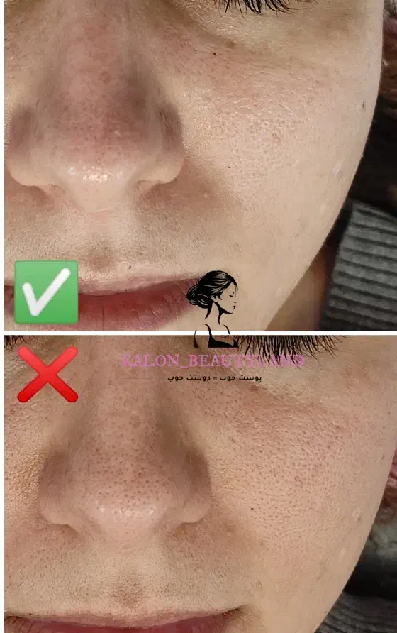 فیشال تخصصی پوست آقایان و بانوان|خدمات آرایشگری و زیبایی|گلبهار, شهر جدید گلبهار|دیوار