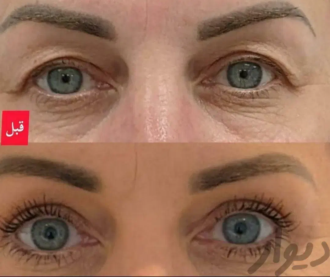 جراحی زیبائی پلک بالا|خدمات آرایشگری و زیبایی|گلپایگان, |دیوار