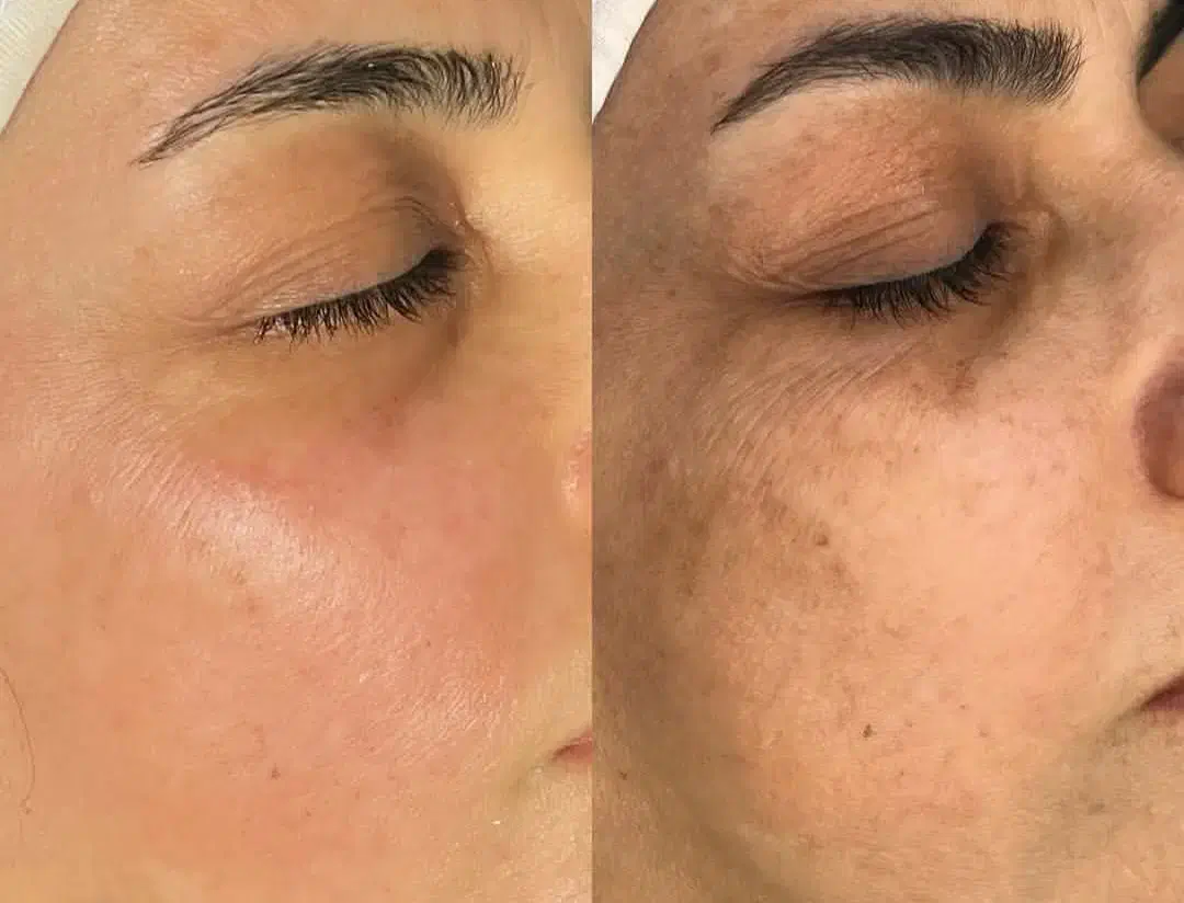 پاکسازی و جوانسازی پوست|خدمات آرایشگری و زیبایی|ورزنه, |دیوار