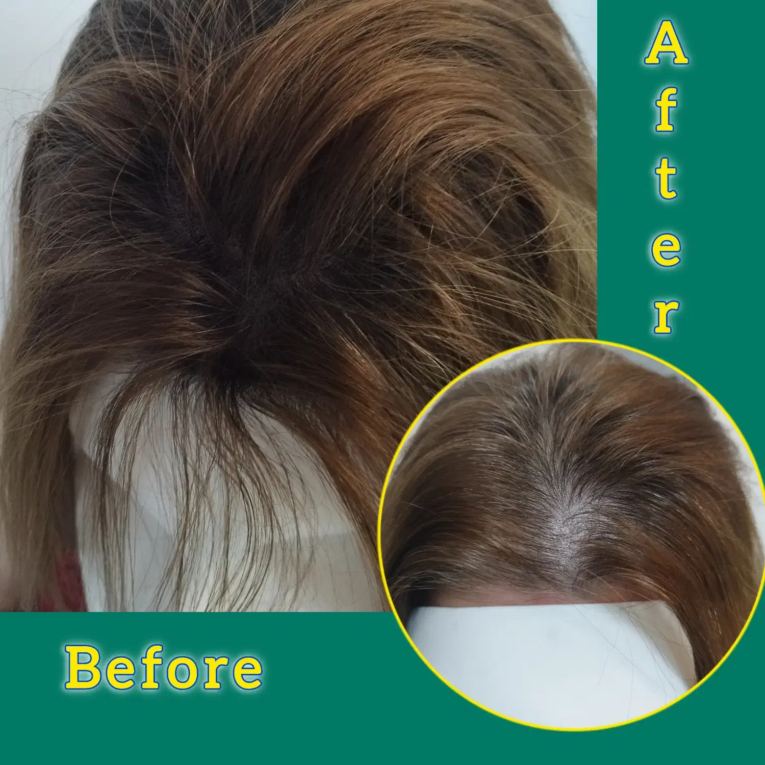 میکرواسکالپ رشد مجدد مو|خدمات آرایشگری و زیبایی|رشت, بوسار|دیوار