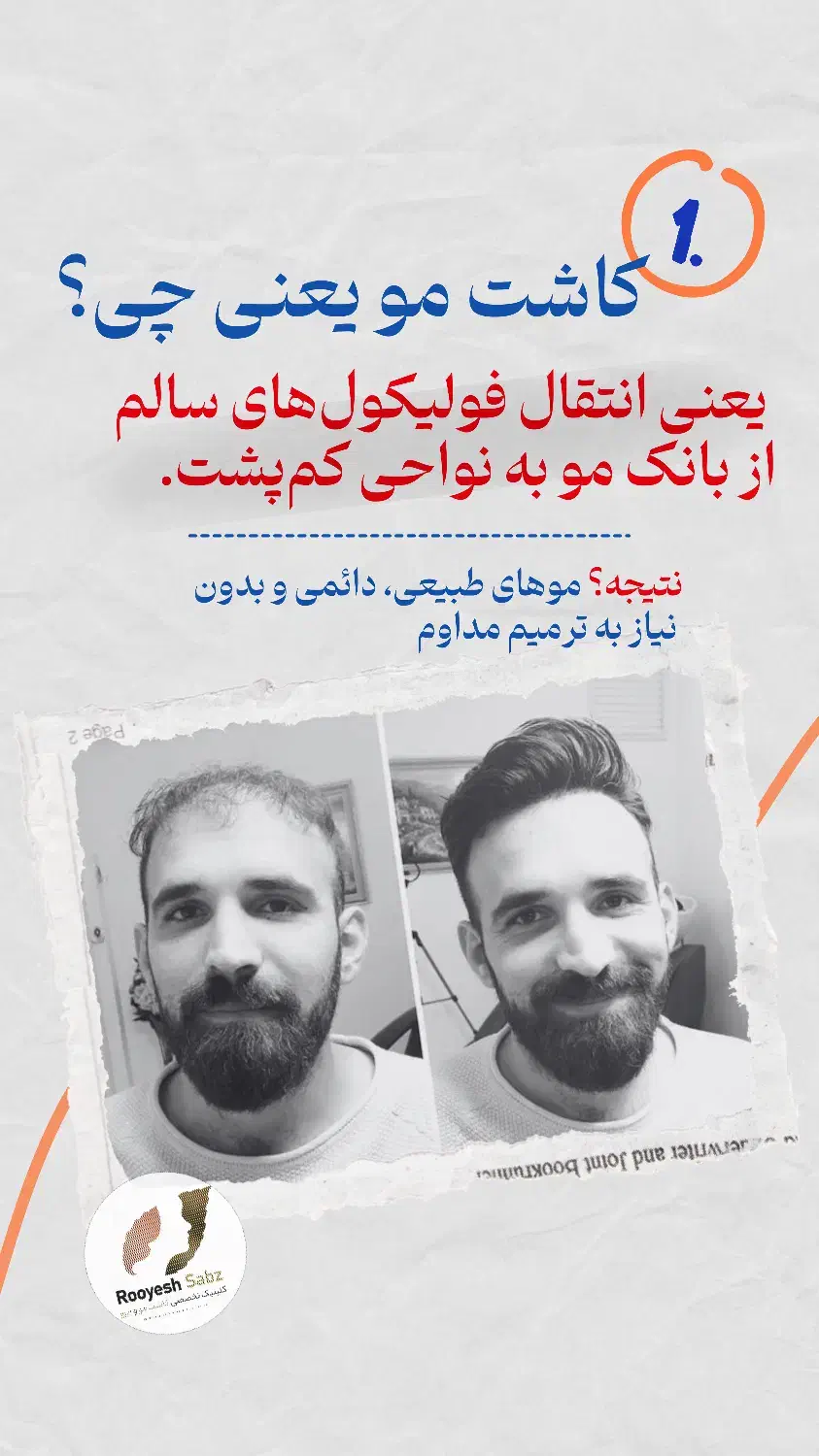 کاشت مو و ابرو|خدمات آرایشگری و زیبایی|تهران, جردن|دیوار