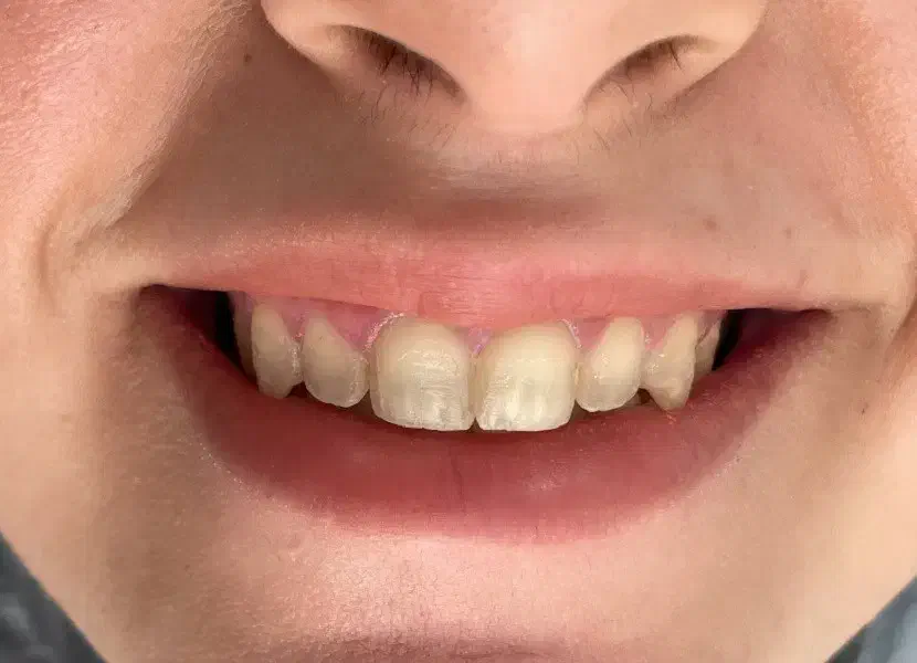 اقساط زیبایی ایمپلنت لمینیت کامپوزیت سجاد بهارستان|خدمات آرایشگری و زیبایی|مشهد, سجاد شهر|دیوار