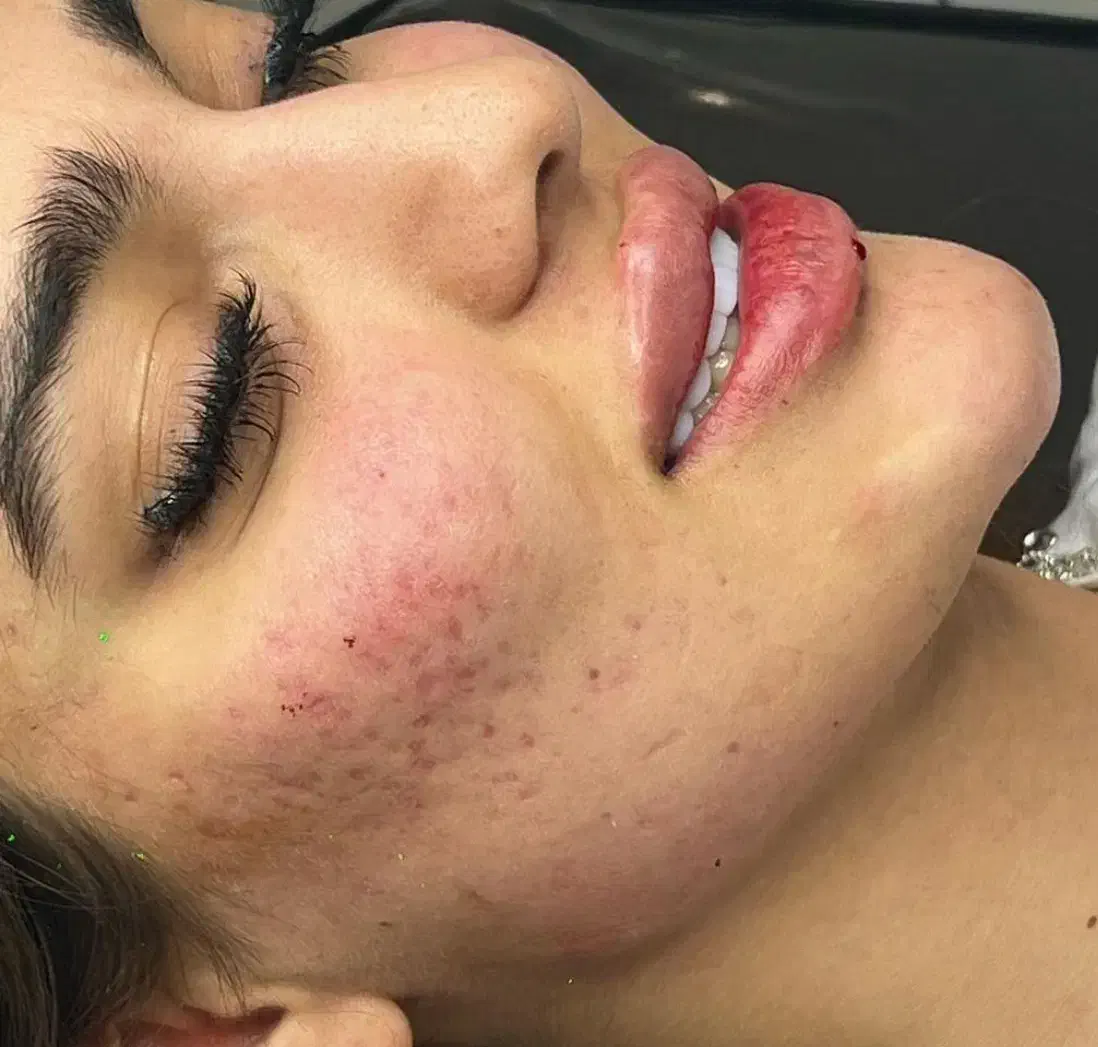 تخفیفات ژل وبوتاکس ومزوژل به مناسبت یلدا|خدمات آرایشگری و زیبایی|قم, زنبیل آباد|دیوار