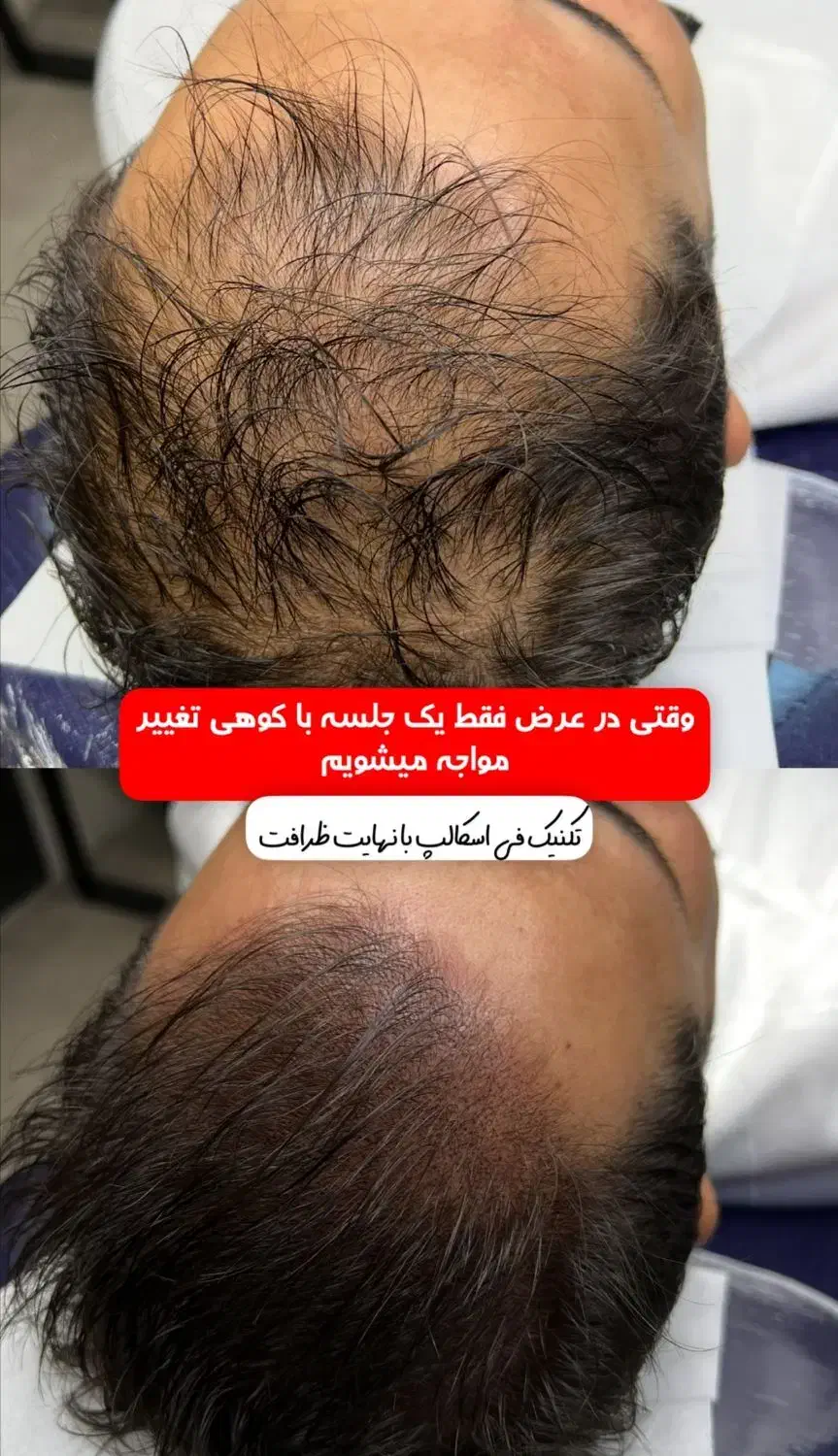 میکرواسکالپ فی اسکالپ سر|خدمات آرایشگری و زیبایی|شیراز, ملاصدرا|دیوار