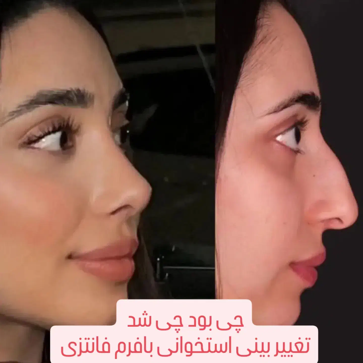 عمل زیبایی بینی در تهران با فوق تخصص نقد و اقساط|خدمات آرایشگری و زیبایی|اصفهان, فرح آباد|دیوار