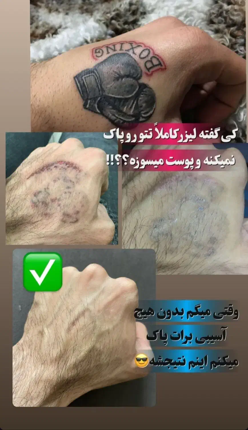 لیزر موهای زائد به مدت محدود فول ۴۹۰|خدمات آرایشگری و زیبایی|ارومیه, |دیوار