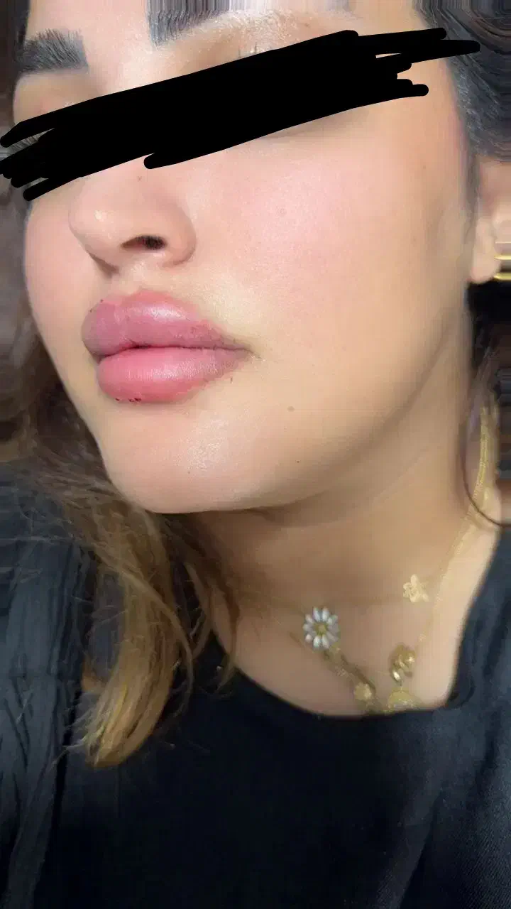 تزریق ژل ،فیلر بوتاکس مزو آنزیم خال برداری|خدمات آرایشگری و زیبایی|الیگودرز, |دیوار