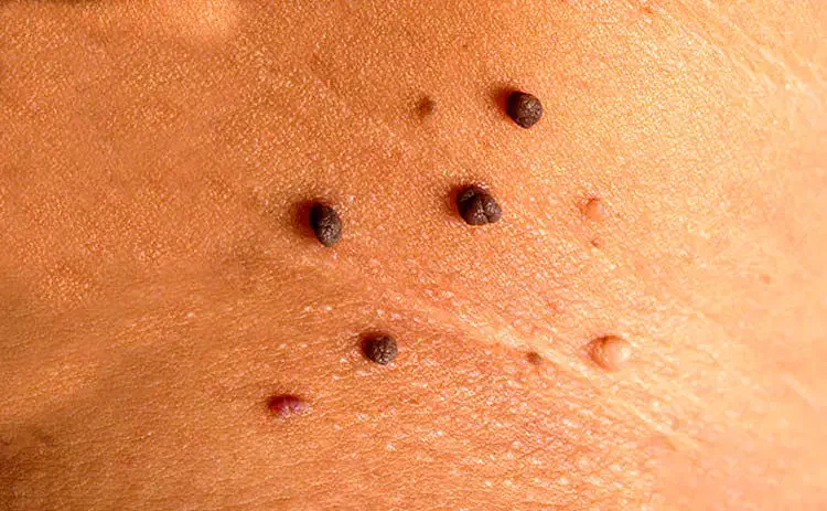 دستگاه خال برداری وزگیل برداری حتی جا های حساس|آرایشی، بهداشتی، درمانی|آبادان, |دیوار