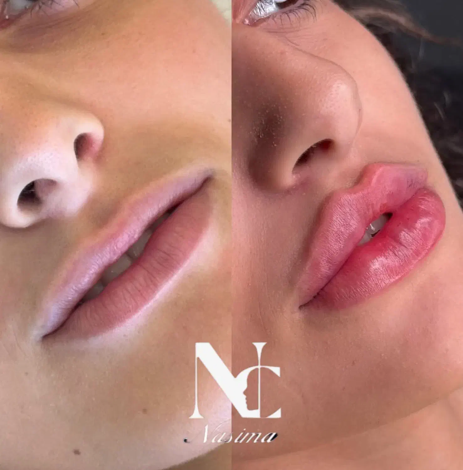 تزریق فیلر بوتاکس،نخ لیفتینگ بانصف قیمت بازار|خدمات آرایشگری و زیبایی|کرمانشاه, |دیوار