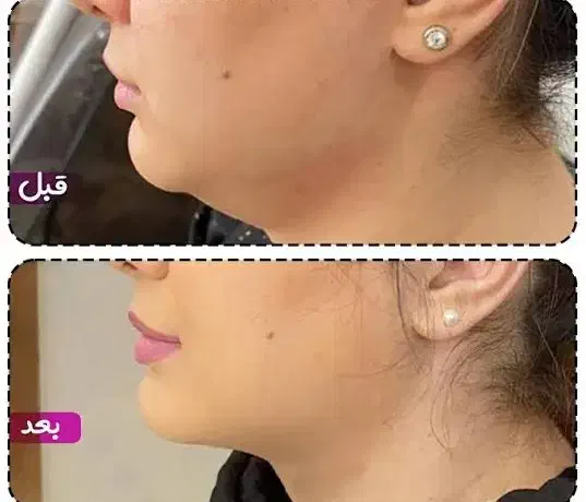 مزو رشدمو لاغری کاملارایگان،ژل بوتاکس انزیم|خدمات آرایشگری و زیبایی|قم, زنبیل آباد|دیوار