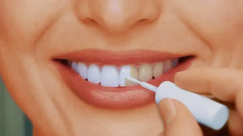 سفید کننده دندان اصل|آرایشی، بهداشتی، درمانی|اهواز, زیتون کارمندی|دیوار