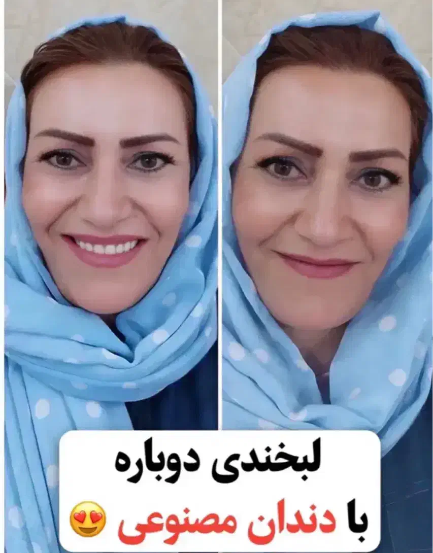 دندان مصنوعی ایتالیایی کامل ۱۵ میلیون بدون بیمه|خدمات آرایشگری و زیبایی|شیراز, کوشک میدان|دیوار