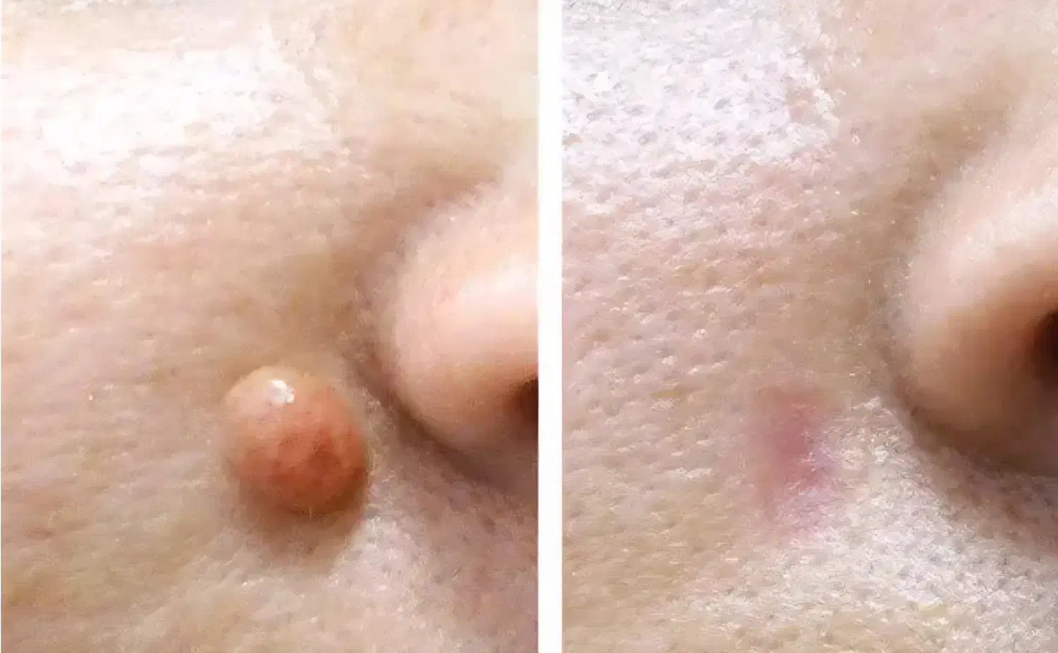 خال برداری ومزونیدلینگ وپلاسما|خدمات آرایشگری و زیبایی|قم, نیروگاه|دیوار