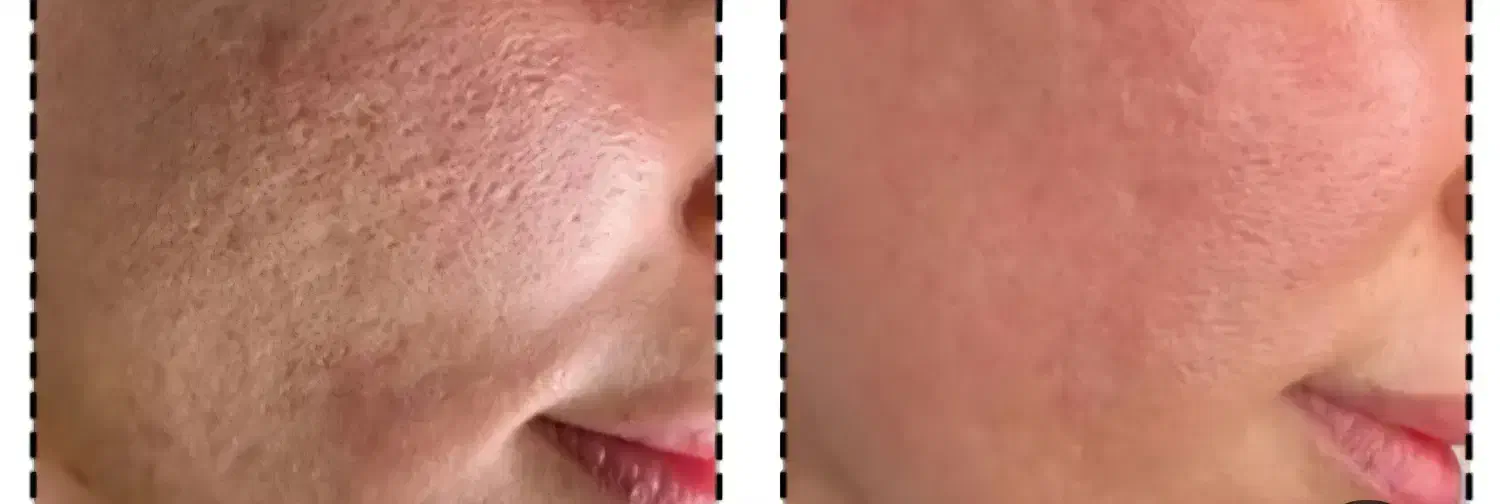 خال برداری ومزونیدلینگ وپلاسما|خدمات آرایشگری و زیبایی|قم, نیروگاه|دیوار