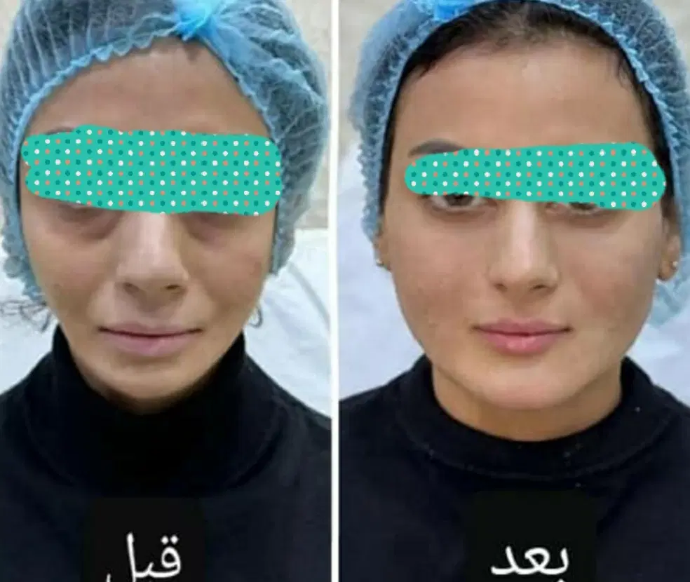 جشنواره تخفیف ژل و بوتاکس و جوانساز|خدمات زیبایی و سلامت|شیراز, فرهنگ شهر|دیوار