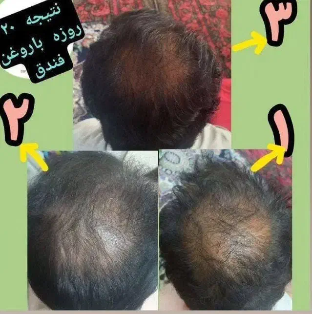 رفع مشکلات پوست و مو|آرایشی، بهداشتی، درمانی|بندر ترکمن, |دیوار