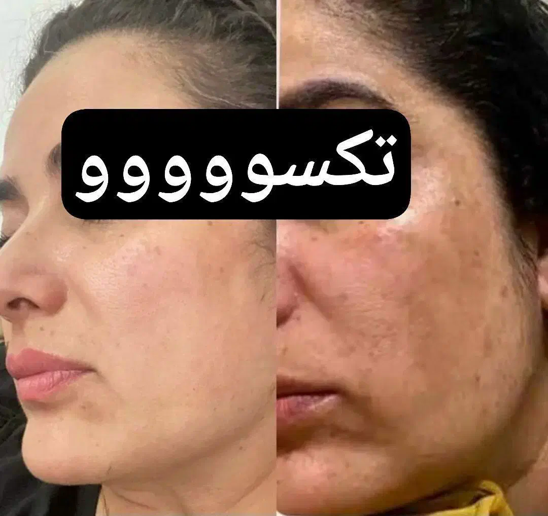 باتکسو زیبا شو اونم بدون عوارض وتضمینی|آرایشی، بهداشتی، درمانی|مشهد, شهرک ابوذر|دیوار