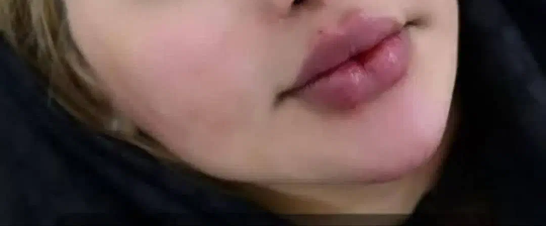 تزریق ژل و بوتاکس|خدمات آرایشگری و زیبایی|اهواز, نادری|دیوار
