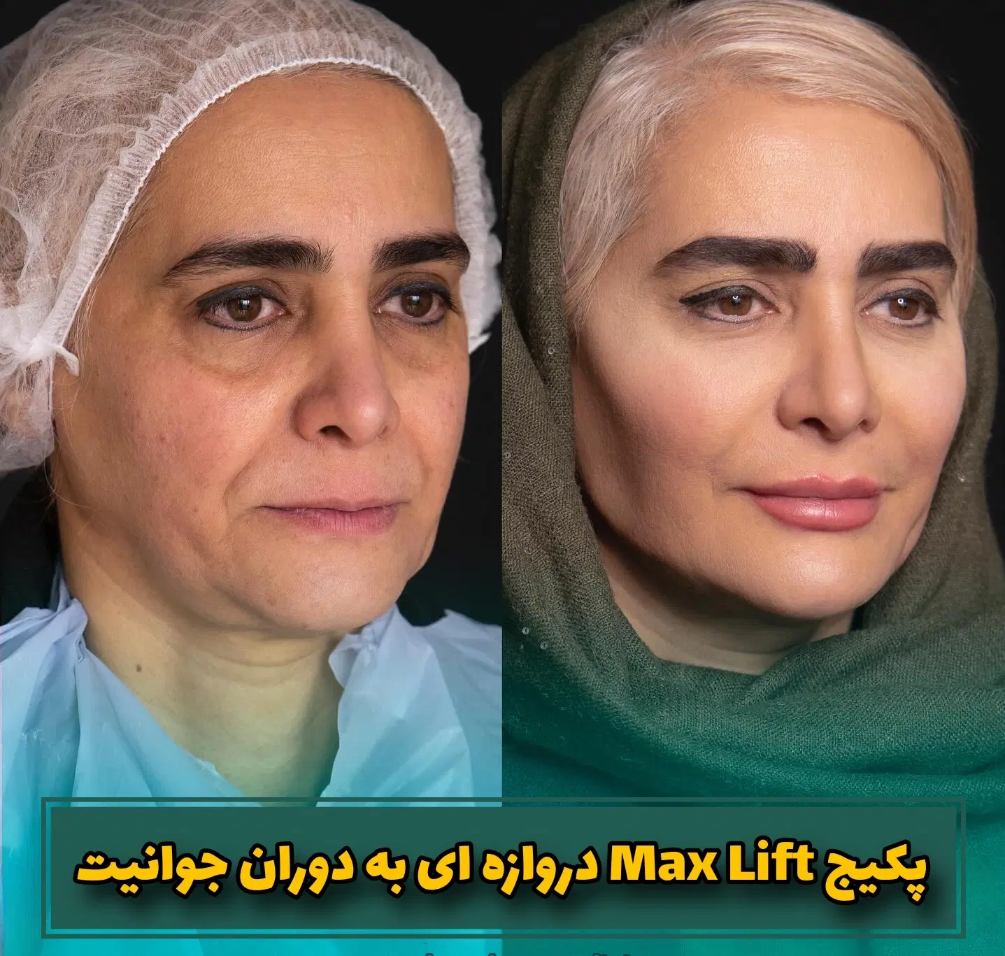 جشنواره جوانسازیMax Lift پزشک پوست مو ژل بینی ابرو|خدمات زیبایی و سلامت|مشهد, هفت تیر (حافظ)|دیوار