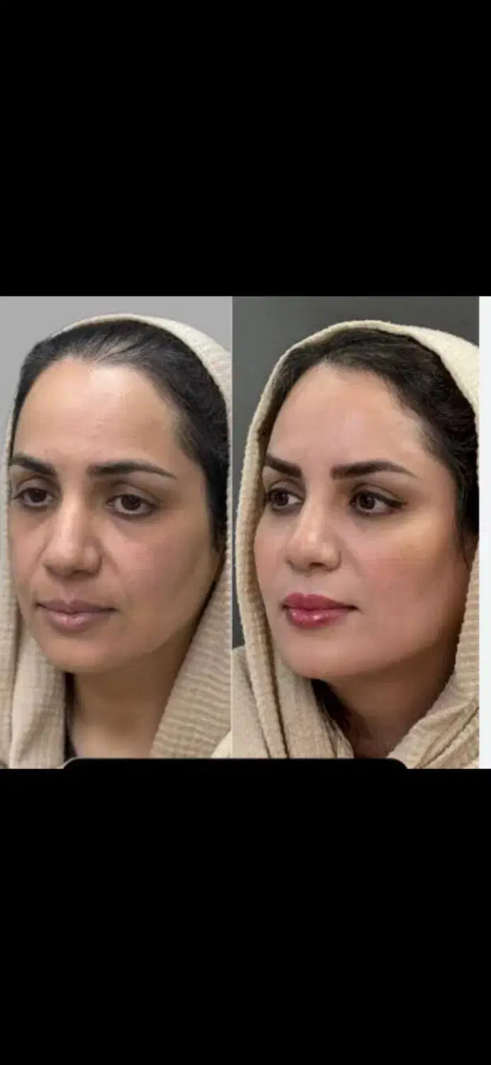 مدل برای جوانسازی وچروک و لک، زیبایی حق شماست|خدمات آرایشگری و زیبایی|رشت, پیرسرا|دیوار