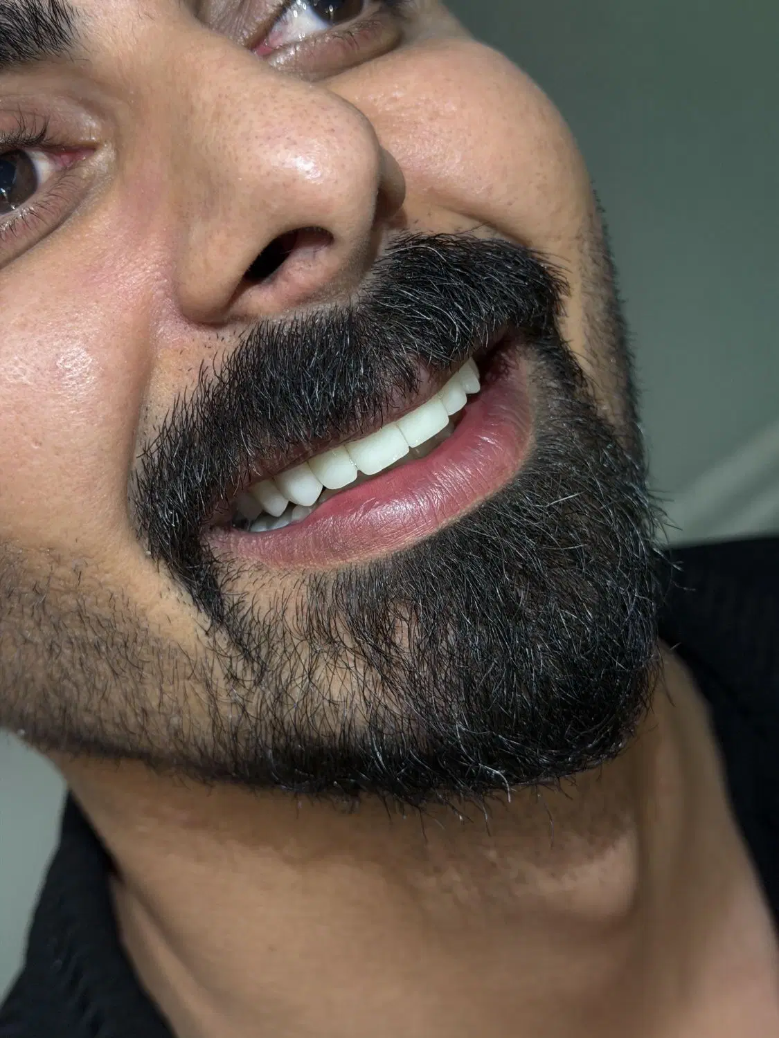 کامپوزیت/اقساط/لمینت/عصبکشی|خدمات زیبایی و سلامت|تهران, سازمان برنامه شمالی|دیوار