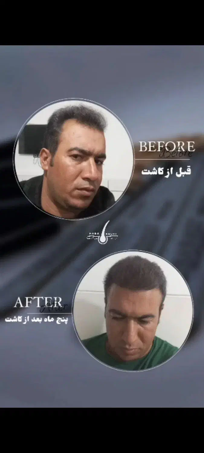 کاشت مو و کاشت اَبرو|خدمات آرایشگری و زیبایی|فسا, |دیوار