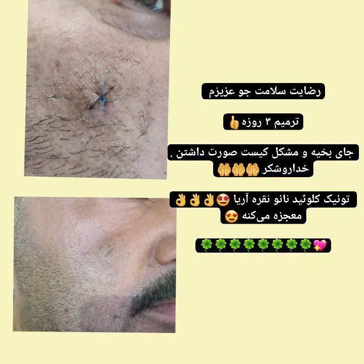 رفع ترک پا و بهبود جای زخم|آرایشی، بهداشتی، درمانی|شیراز, عفیف‌آباد|دیوار