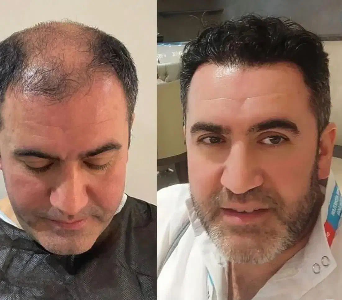 کاشت مو و ابرو تخصصی|خدمات آرایشگری و زیبایی|رشت, گلسار|دیوار