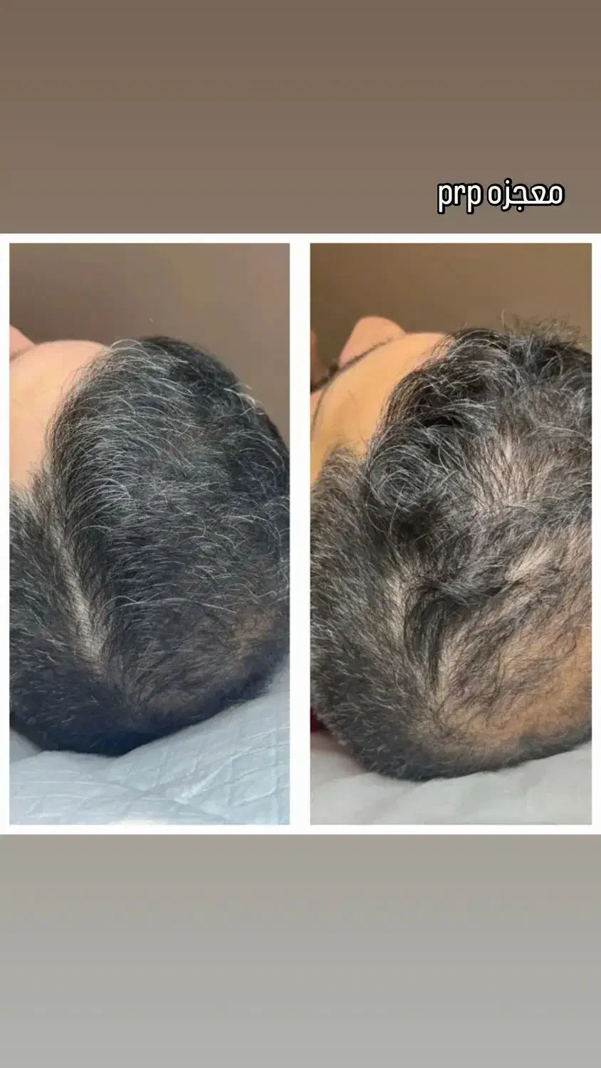 خواهان مدل برای prp مو و صورت|خدمات آرایشگری و زیبایی|سنندج, |دیوار