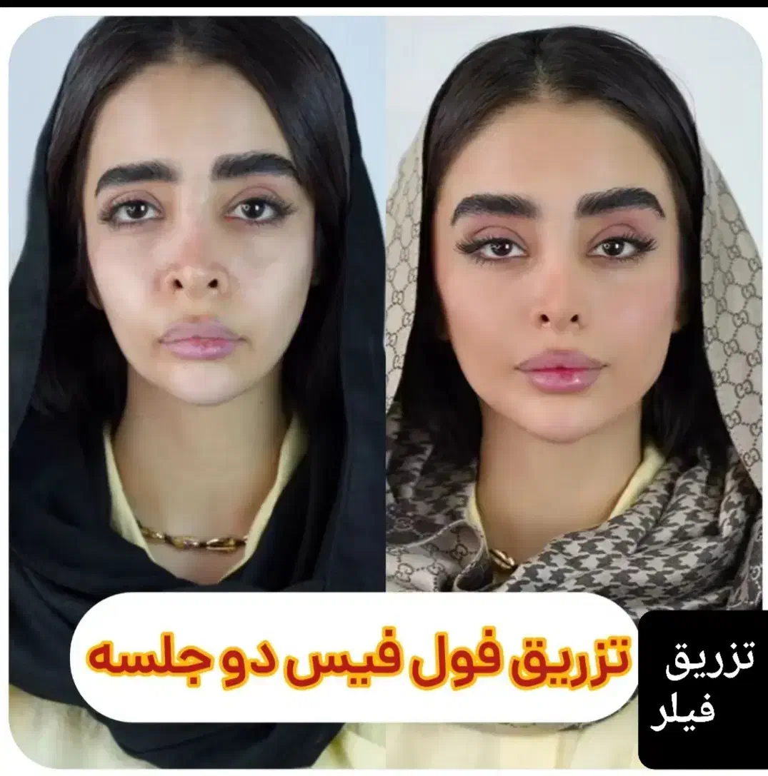 برداشتن خال۱۰ هزار تومن دریک جلسه،فیلر۳۰۰،جوانسازی|خدمات آرایشگری و زیبایی|کرج, گوهردشت|دیوار