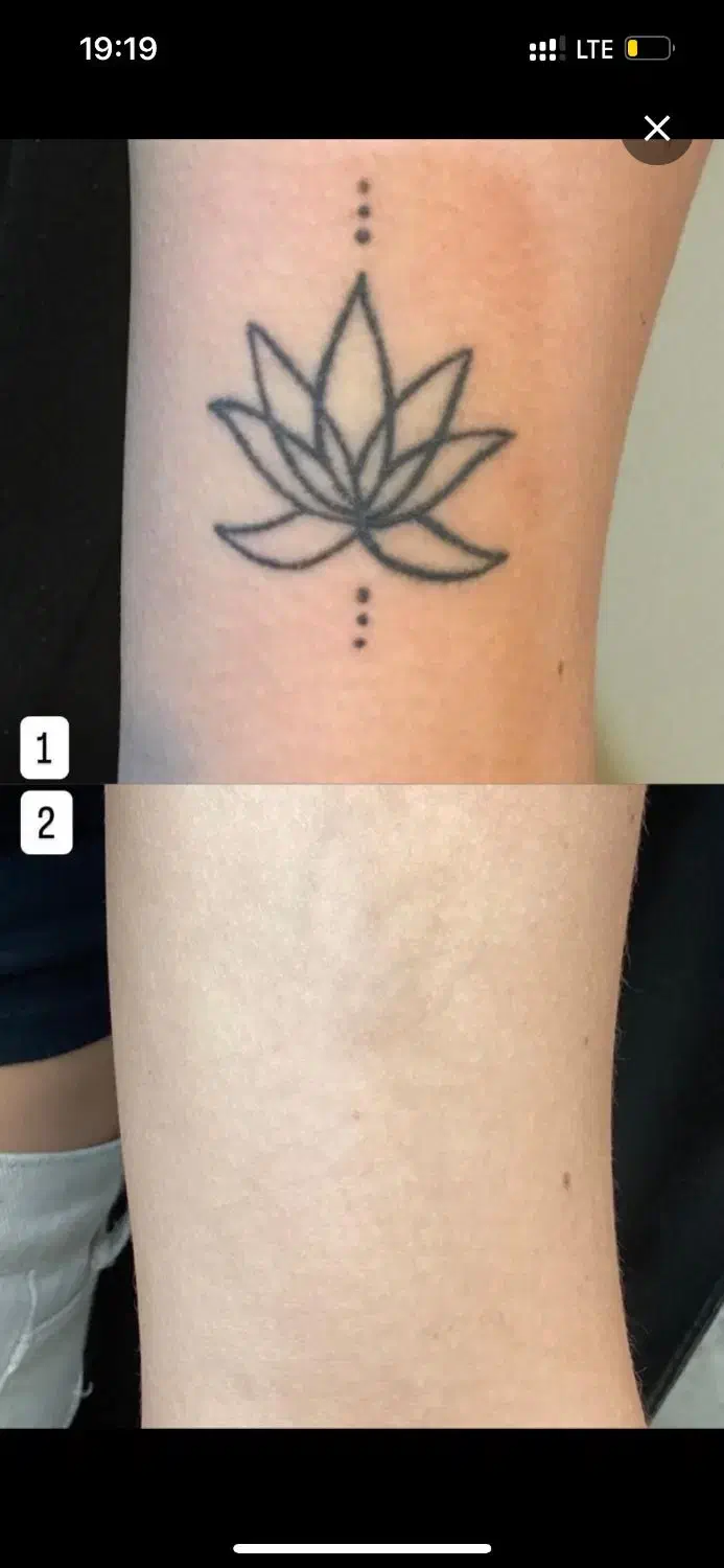 ریموتتو ابرو و بدن با پیشرفته ترین دستگاه تضمینی|خدمات آرایشگری و زیبایی|اهواز, کیانپارس |دیوار