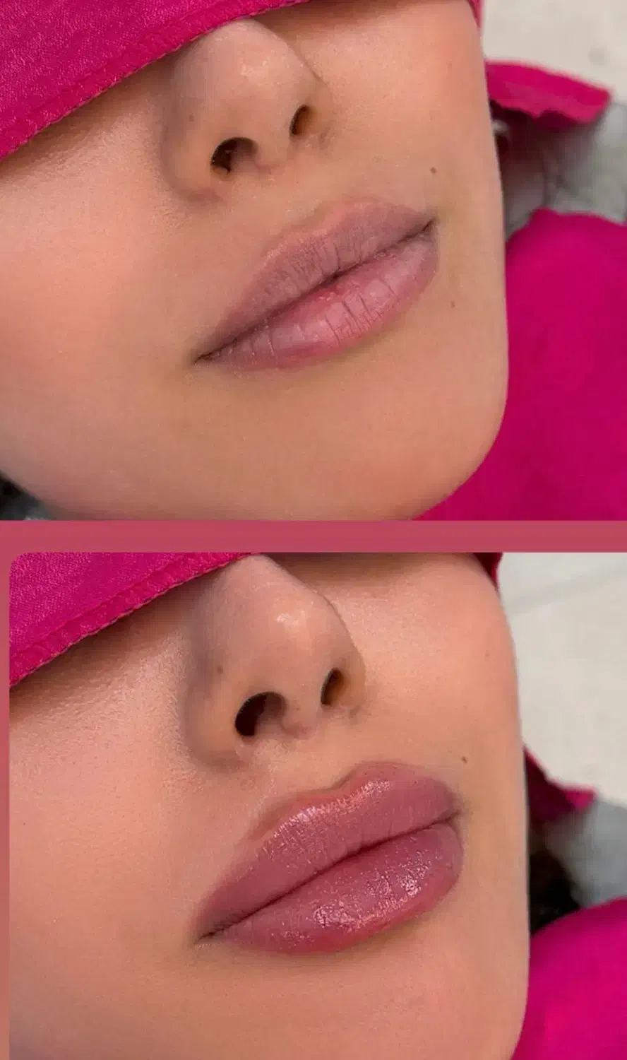 مدل برای تزریق ژل و بوتاکس|خدمات آرایشگری و زیبایی|مشهد, کلاهدوز|دیوار