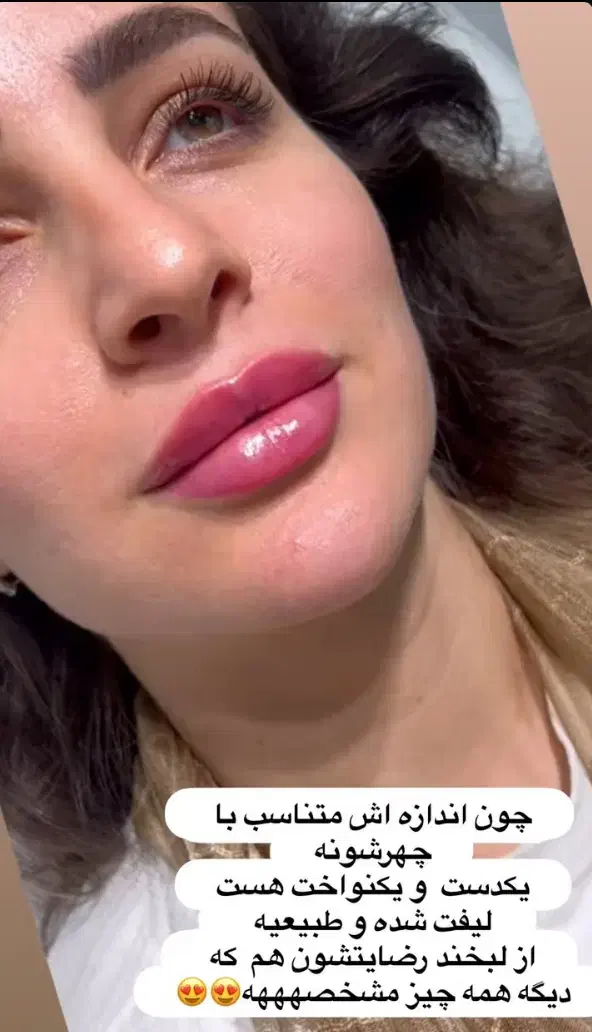 تخفیف تزریق ژل وبوتاکس|خدمات آرایشگری و زیبایی|آمل, |دیوار