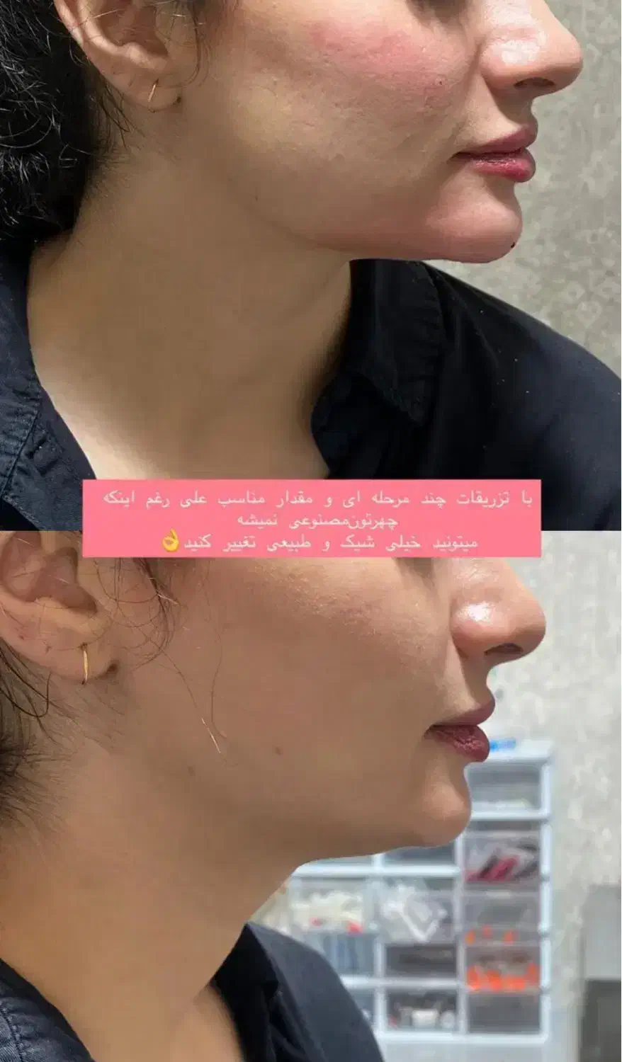 ژل وبوتاکس فیلرمزوپی ارپی آنزیم هایفوبلفاروپلاستی|خدمات آرایشگری و زیبایی|تبریز, |دیوار