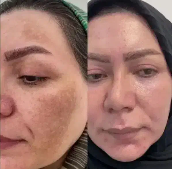 جشنواره درمان کک ومک/لک/خال/ریزش مودریک جلسه|خدمات آرایشگری و زیبایی|اصفهان, طامه|دیوار