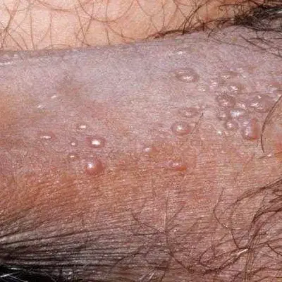 بهبود زگیل تناسلی|آرایشی، بهداشتی، درمانی|کیش, |دیوار