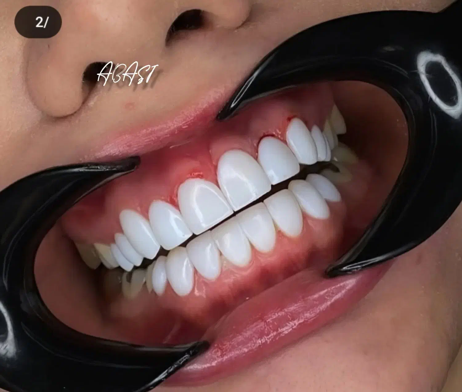 ایمپلنت و کامپوزیت دندان فقط از 10|خدمات آرایشگری و زیبایی|نورآباد, |دیوار