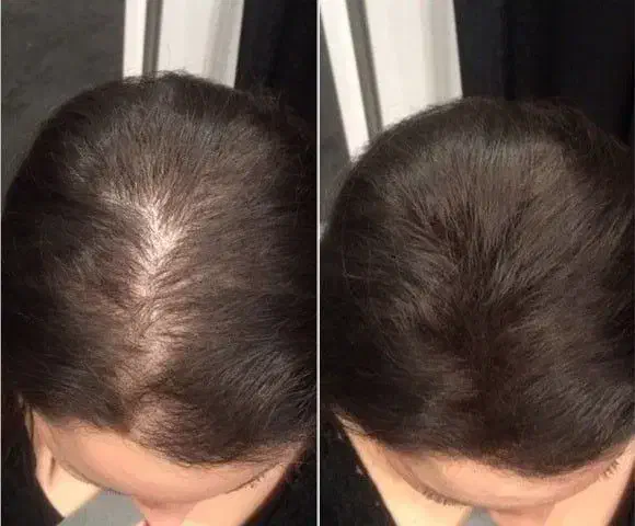 قطع کامل ریزش مو و رویش مو|عمده‌فروشی|محمدشهر, محمدشهر|دیوار