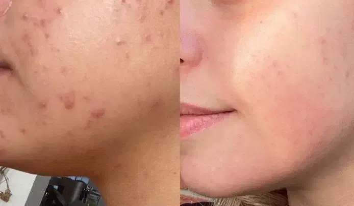 درمان جوش صورت و بدن|خدمات آرایشگری و زیبایی|دوگنبدان, |دیوار