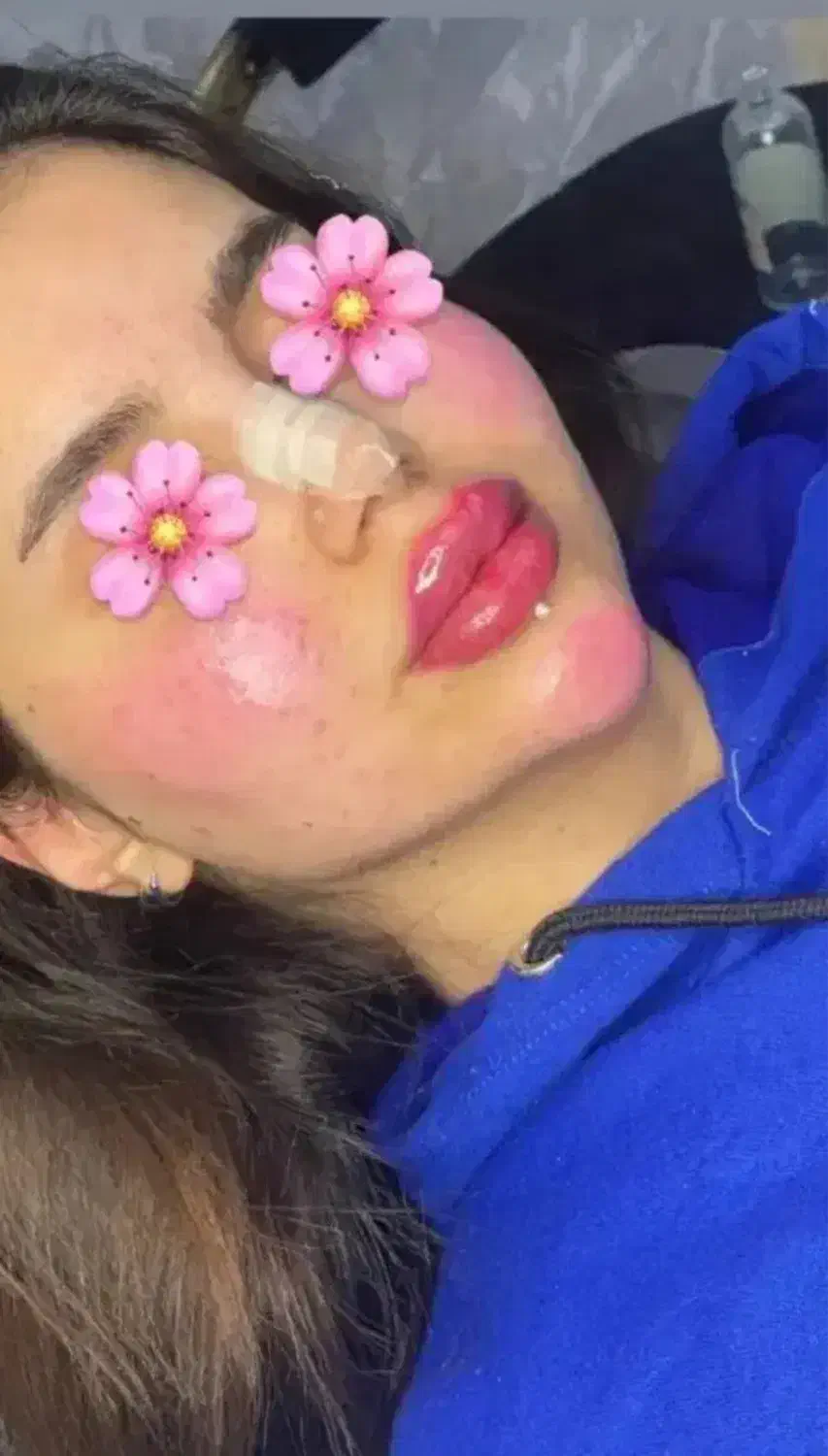 ژل و بوتاکس فقط ۳۹۰|خدمات آرایشگری و زیبایی|قم, زنبیل آباد|دیوار