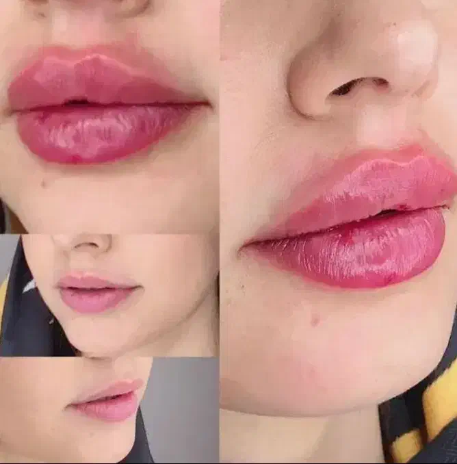 تزریق ژل و فیلر لب،گونه،چانه(جشنواره)درمطب فقط499ت|خدمات آرایشگری و زیبایی|اصفهان, باغ زیار|دیوار