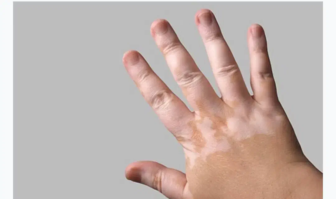 پیسی وویتیلیگو|آرایشی، بهداشتی، درمانی|تیکمه داش, |دیوار