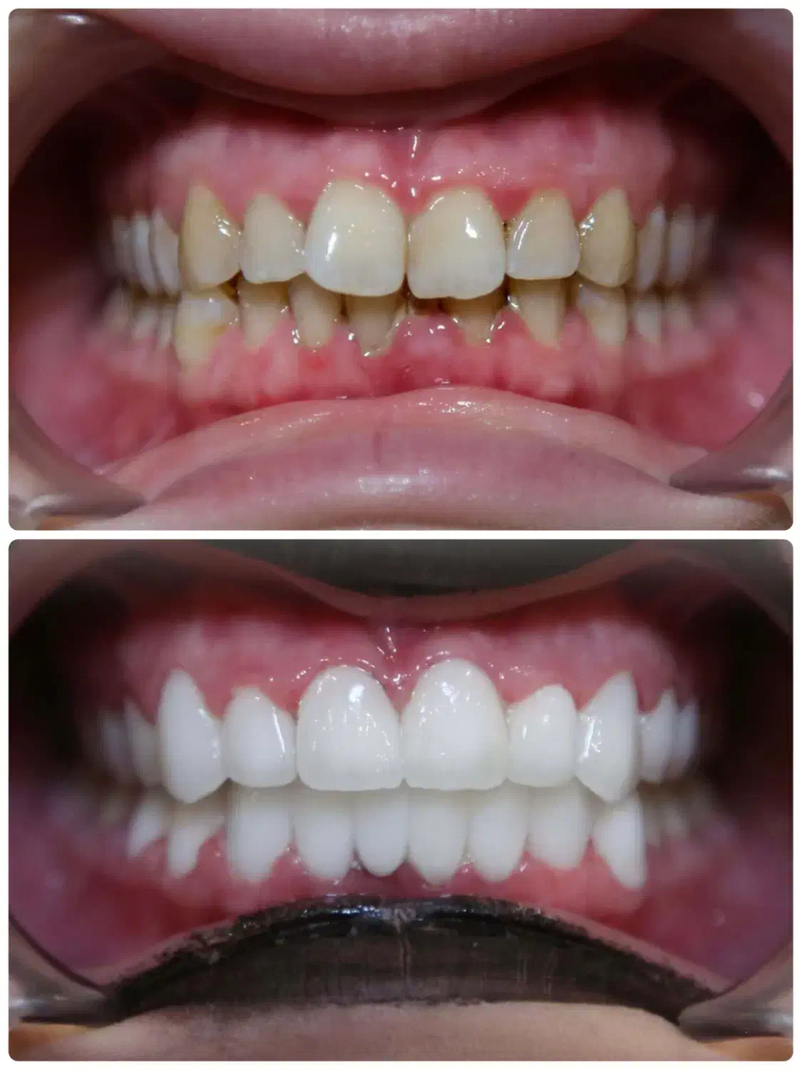 شرایط ویژه کامپوزیت دندان|خدمات آرایشگری و زیبایی|آذرشهر, |دیوار