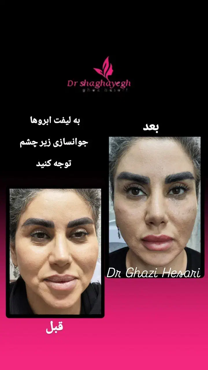 لیزر تزریق بوتاکس ژل فیلر مزوتراپی هایفو توسط پزشک|خدمات آرایشگری و زیبایی|پرند, فاز ۲|دیوار