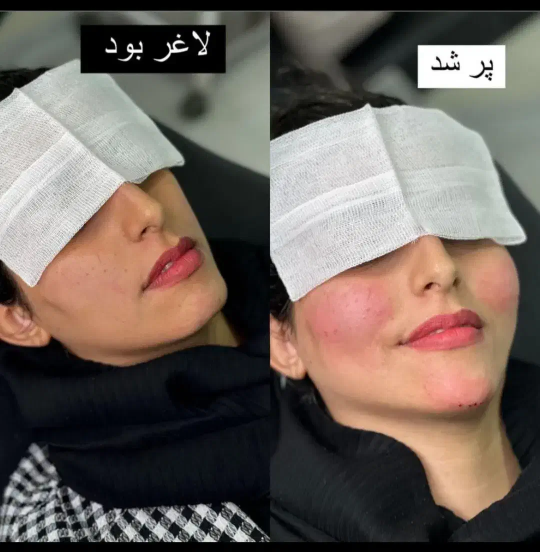 تخفیف جشنواره تزریق ژل و فیلر لب و فول فیس در مطب|خدمات آرایشگری و زیبایی|اصفهان, ملکشهر|دیوار