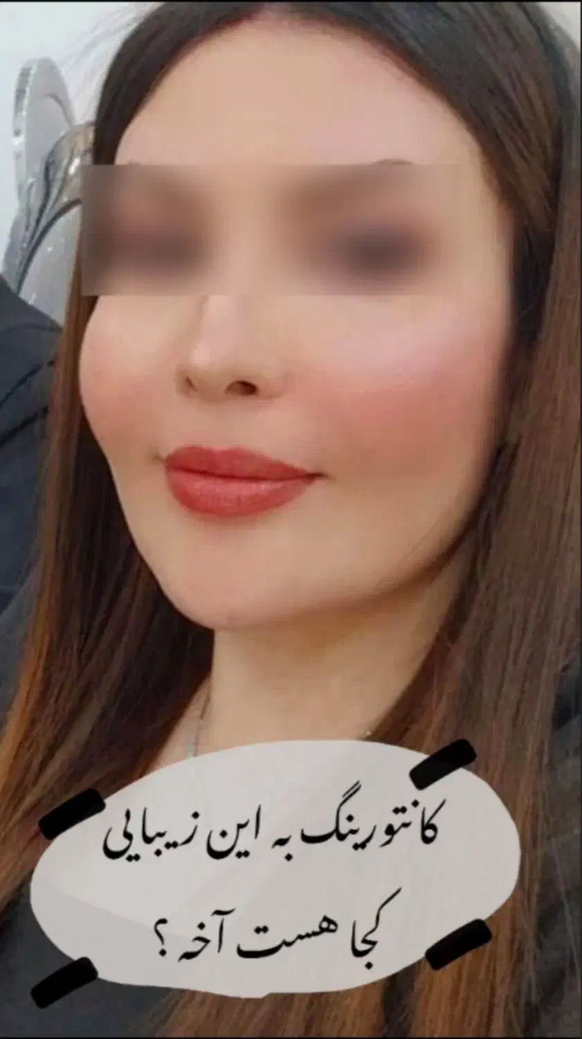 تزریق تخصصی فیلر،بوتاکس،مزو وآنزیم درمطب|خدمات آرایشگری و زیبایی|کرمانشاه, |دیوار