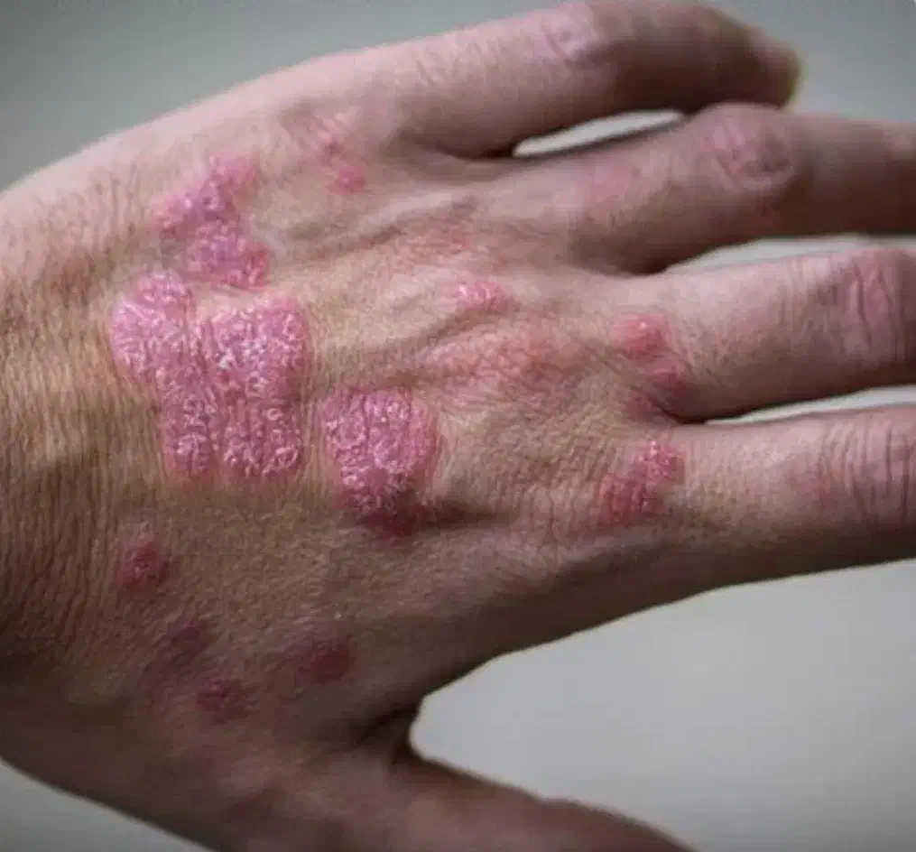 درمان پسوریازیس به صورت ریشه ای|آرایشی، بهداشتی، درمانی|جیرفت, |دیوار